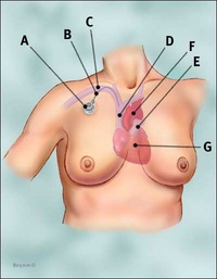 port_chemotherapy