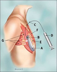 Tissue Expander