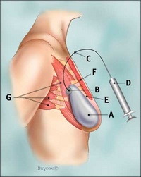 Tissue Expander