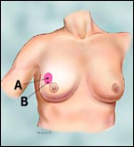 lumpectomy_tcm-small