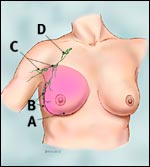 modified_radical_mastectomy_tcm-small