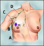 pre_surgery_step1_tcm8-small