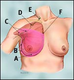 radical_mastectomy_tcm-small