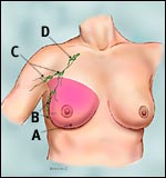 simple_mastectomy_tcm-small